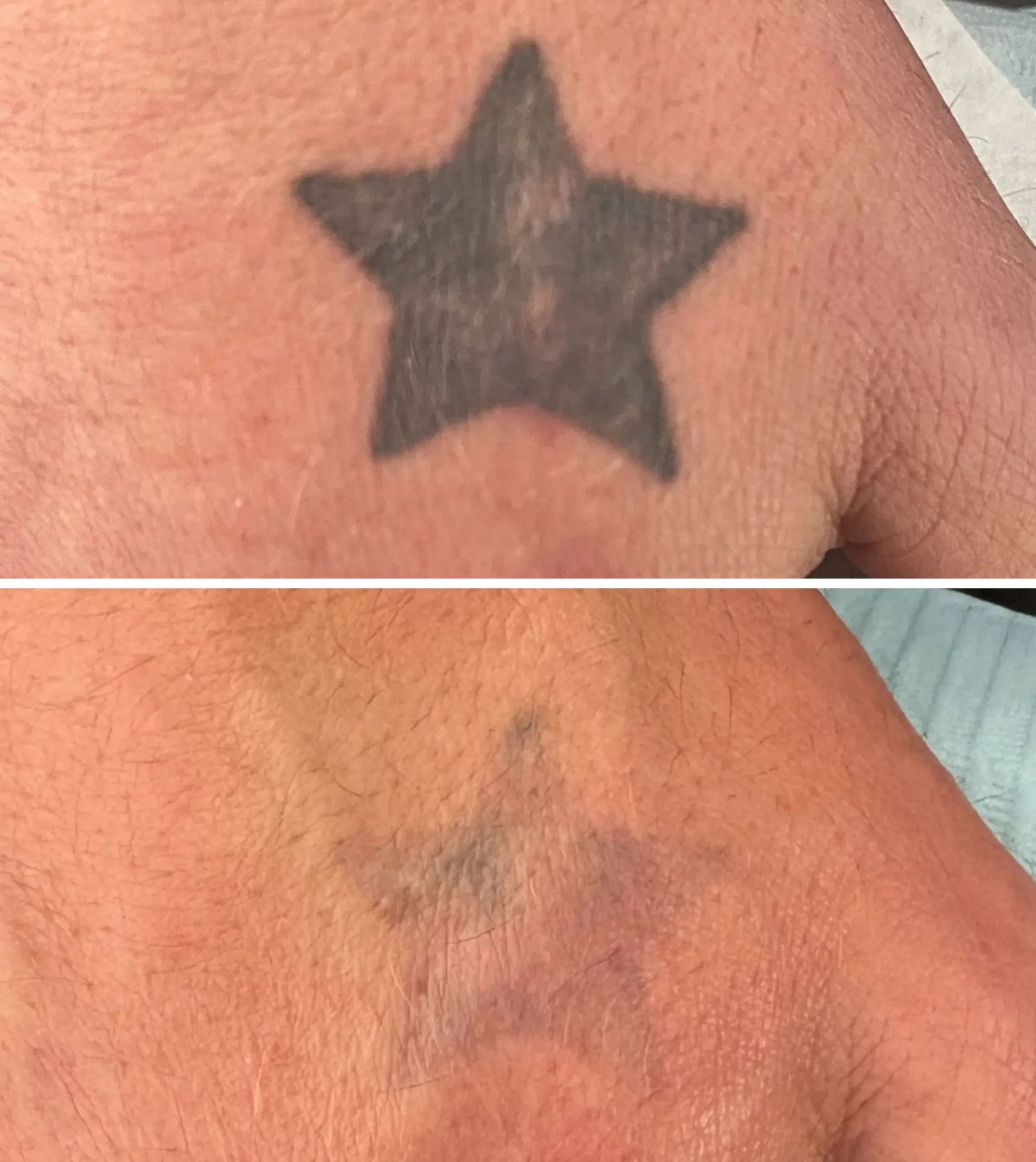 hyperpigmentation after tattoo removal