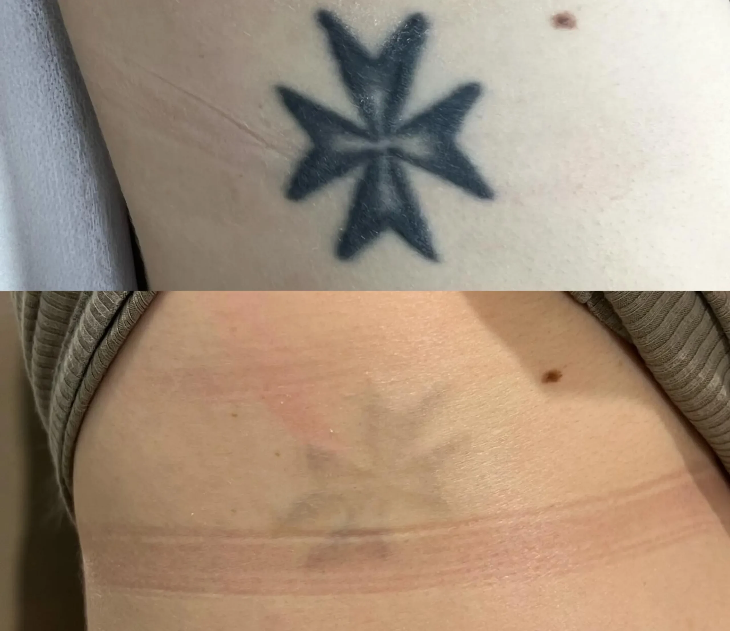 hypopigmentation laser tattoo