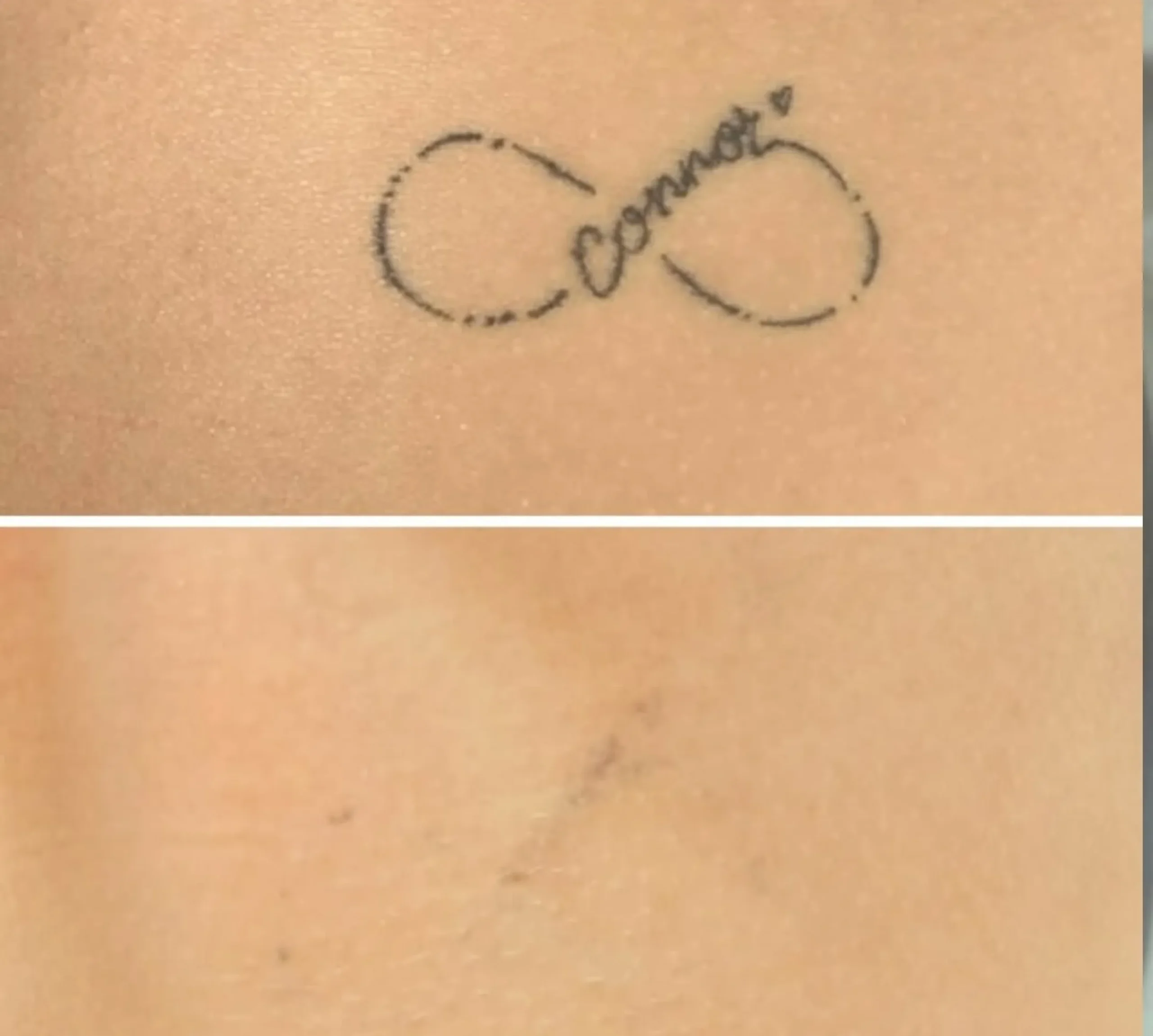 melanin response laser tattoo
