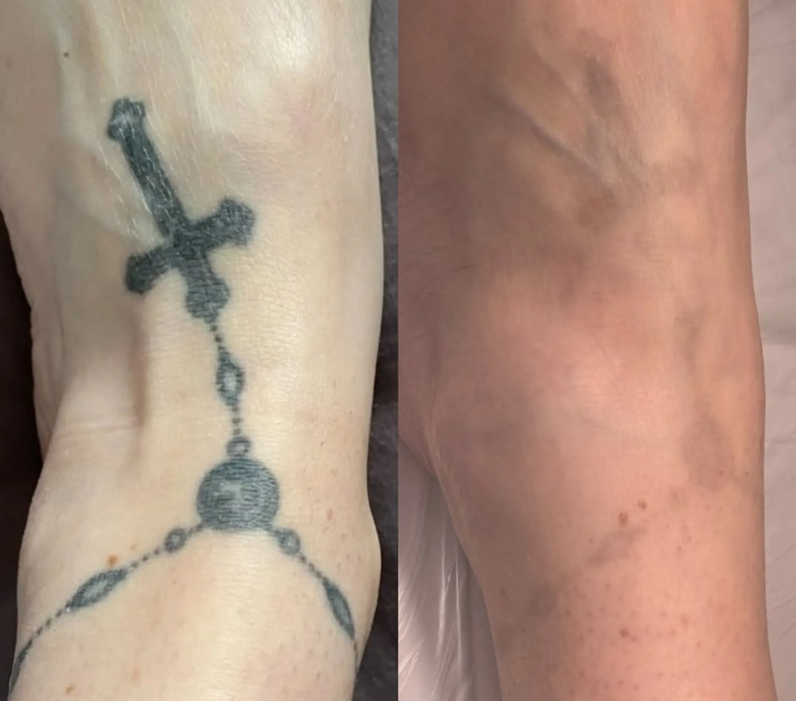 pigment change after tattoo removal