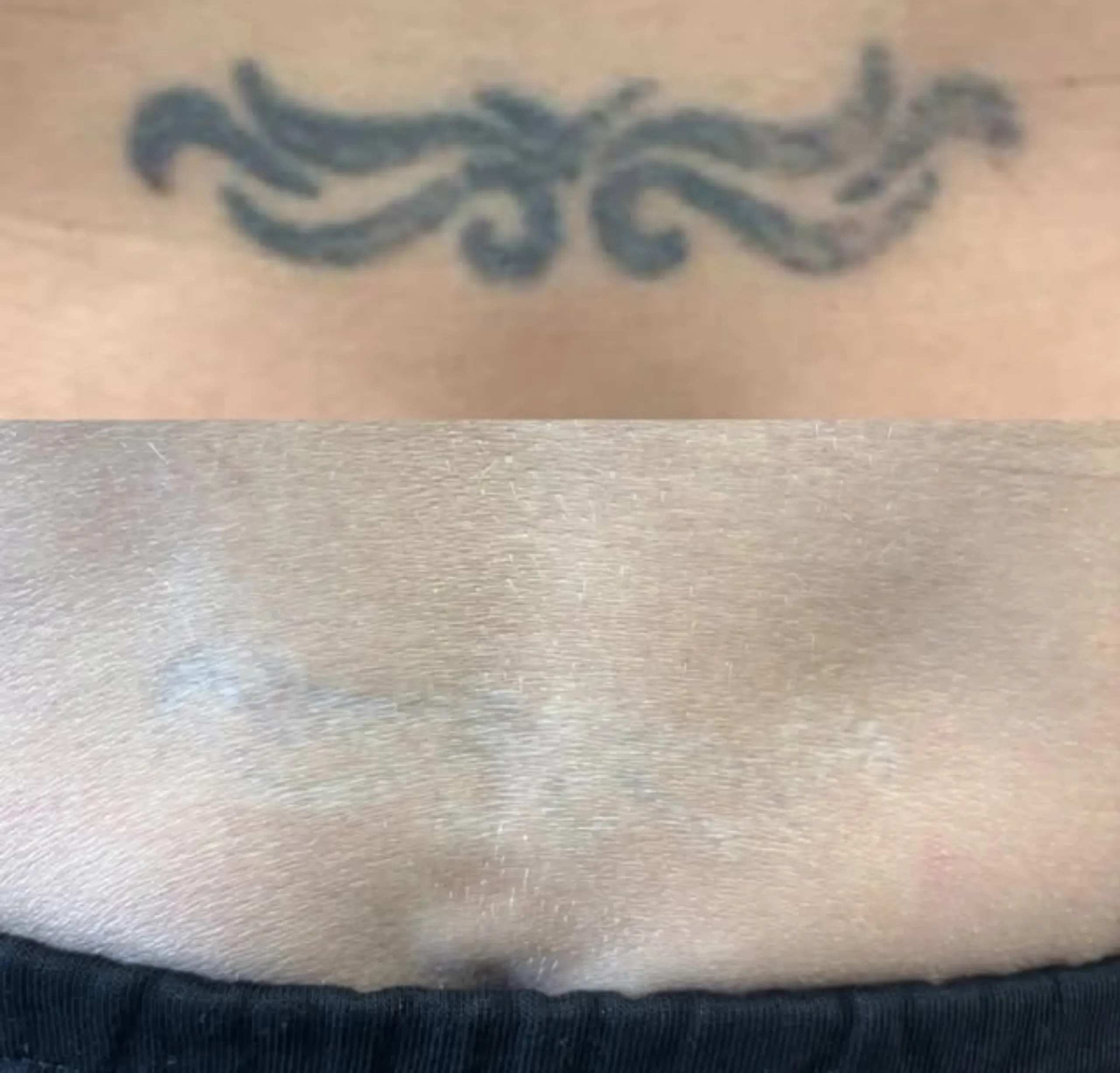 PIH after laser removal