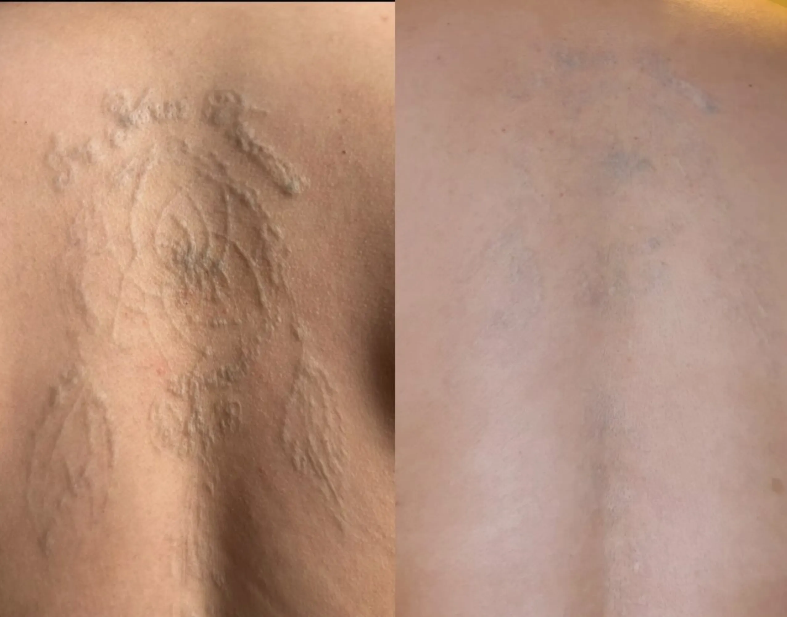 What Is The Risk Of Hyperpigmentation Or Hypopigmentation After Removal?
